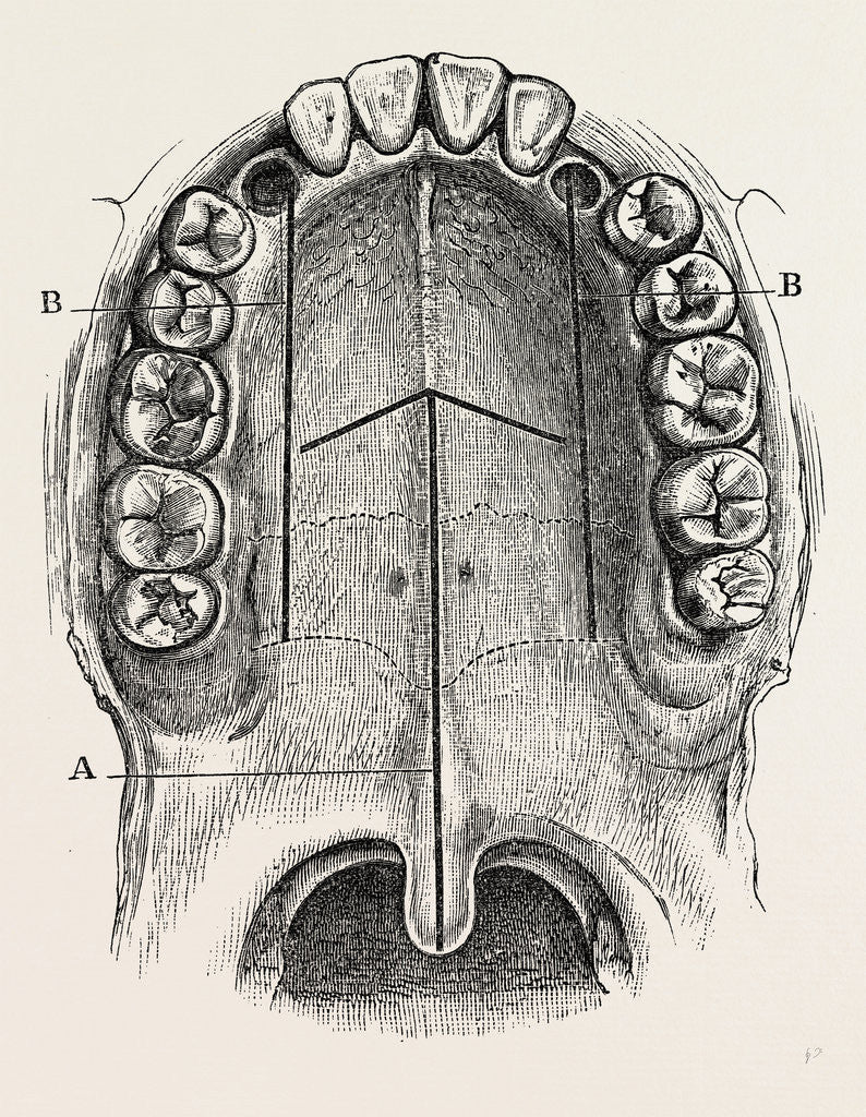 Detail of Nelaton's operation for nasal polypus by Anonymous