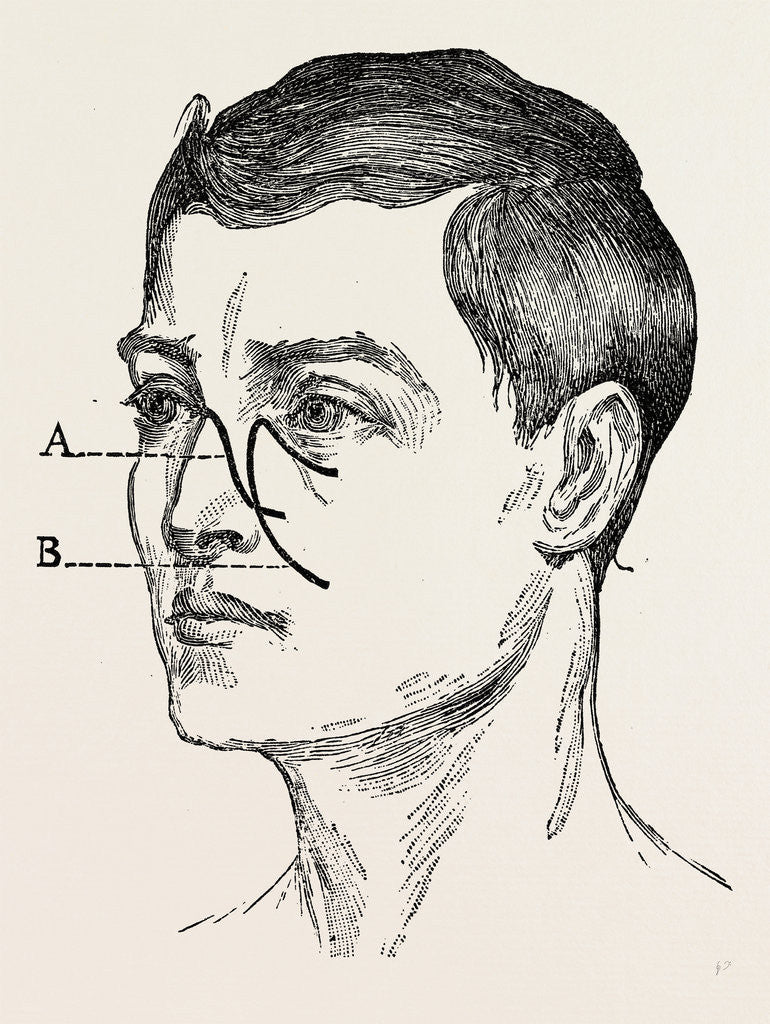 Detail of Operations for naso-pharyn by Anonymous