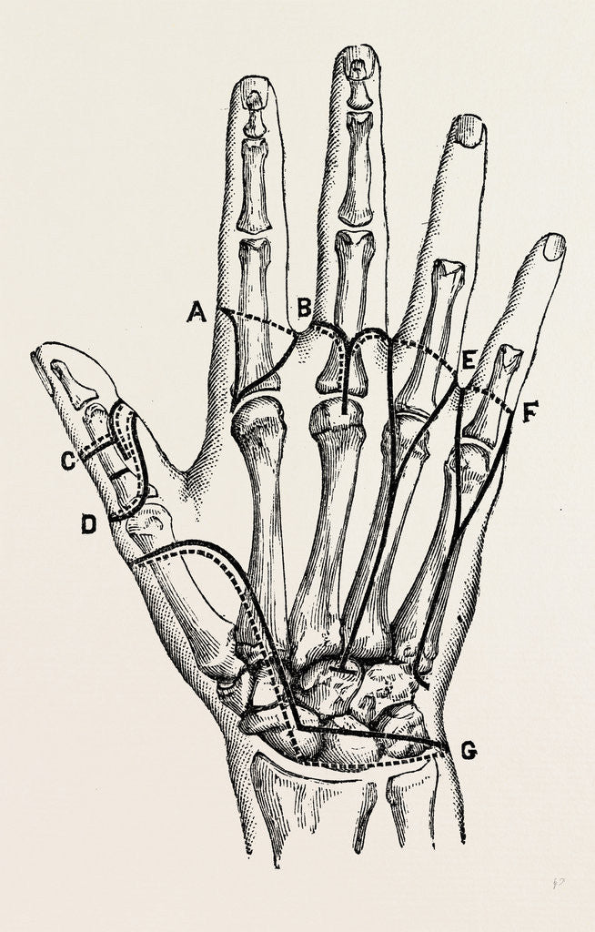 Detail of Disarticulation by Anonymous