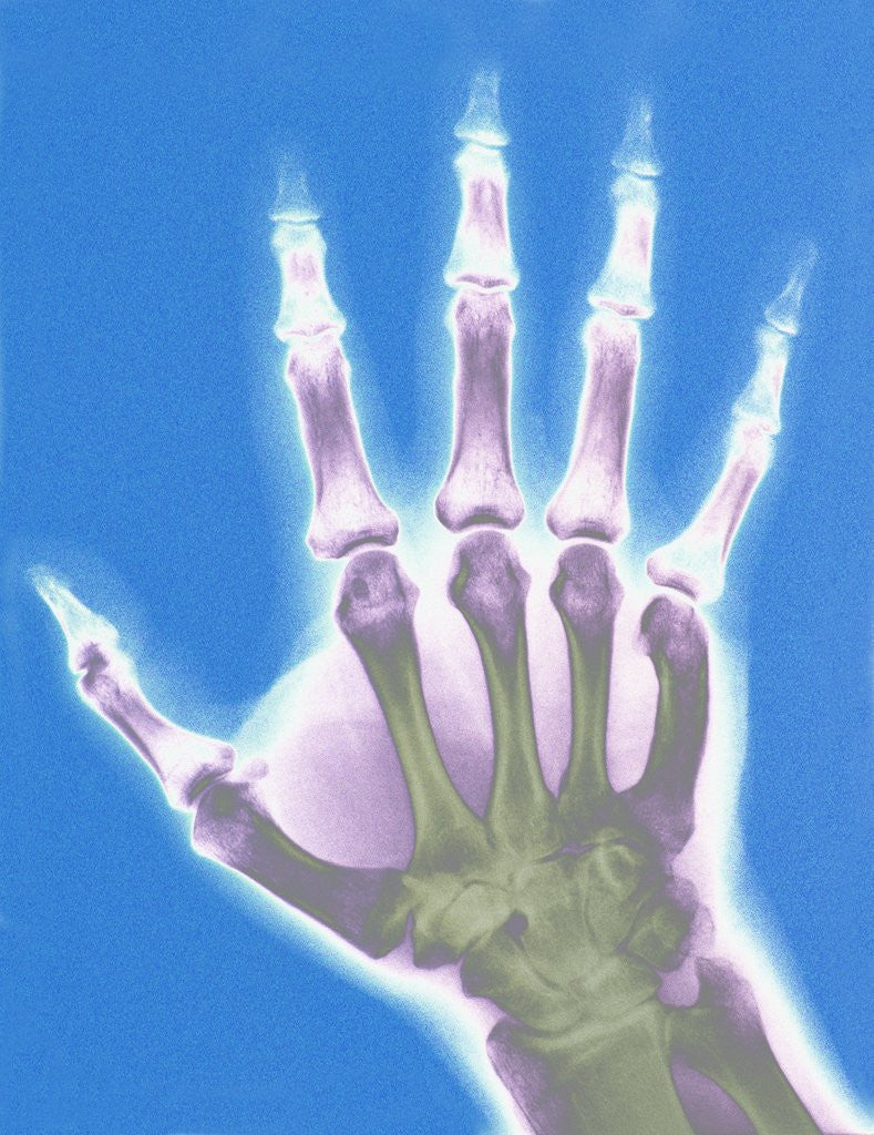 Detail of X-ray of a Hand by Anonymous