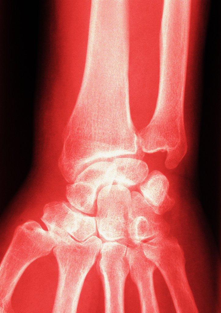 Detail of X-ray of a Wrist by Anonymous
