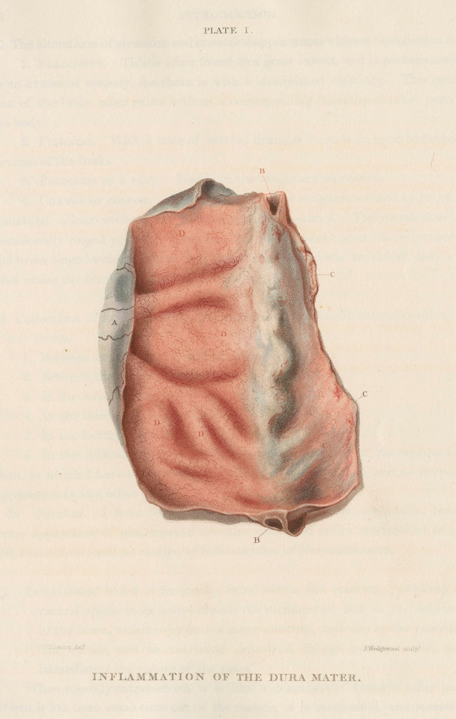 Detail of 'Inflammation of the dura mater' by J Wedgewood