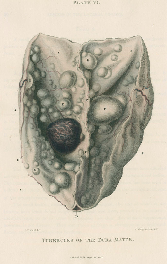 Detail of 'Tumours of the dura mater' by J Wedgewood
