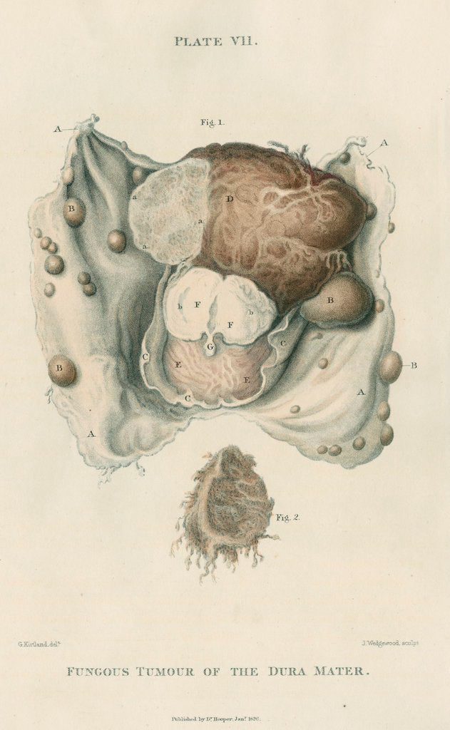 Detail of 'Fungous tumour of the dura mater' by J Wedgewood