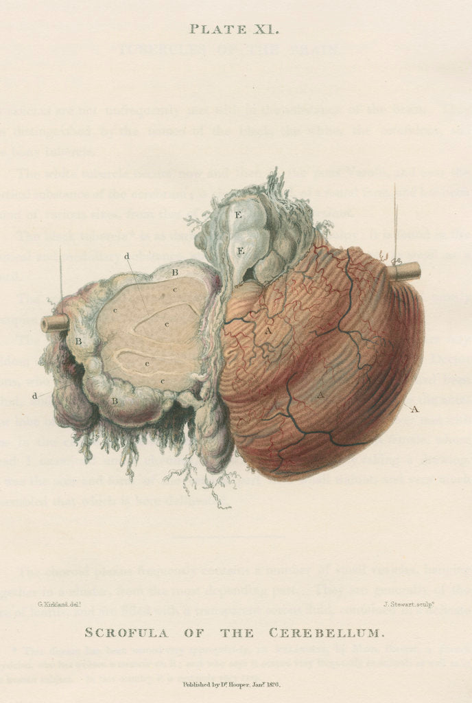 Detail of 'Scrofula of the cerebellum' by J Stewart senior