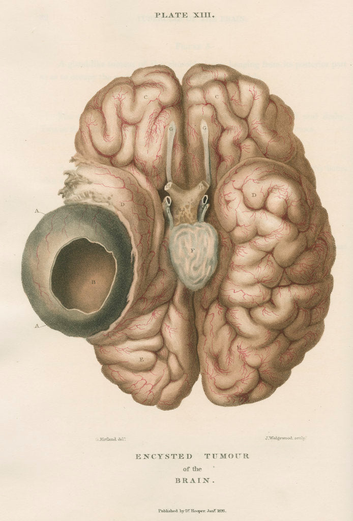 Detail of 'Encysted tumour of the brain' by J Wedgewood