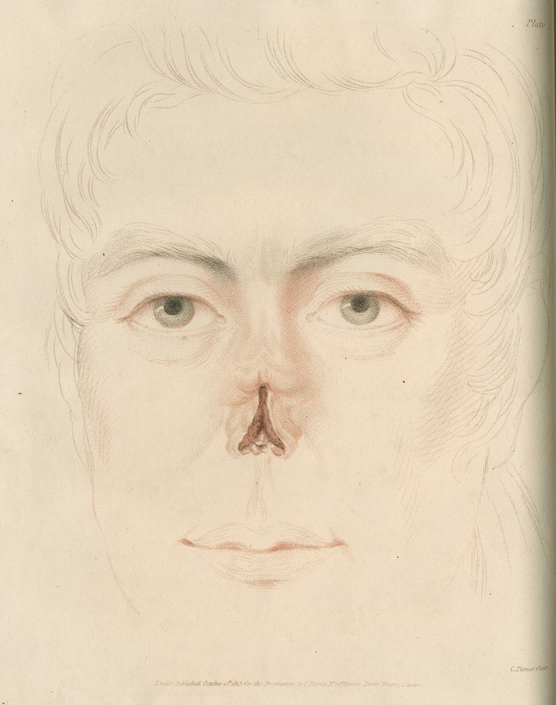 Detail of A candidate for a nose replacement by Charles Turner