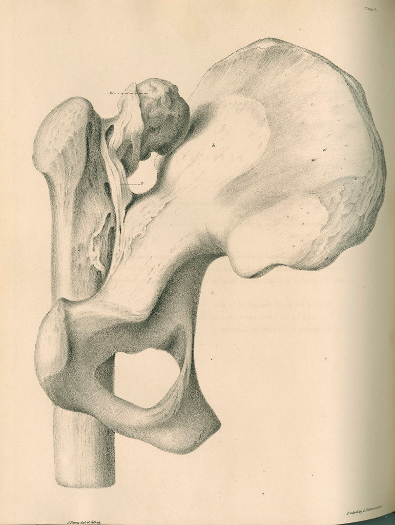 Detail of Posterior view of a left dislocated femur and hip bone by J Perry
