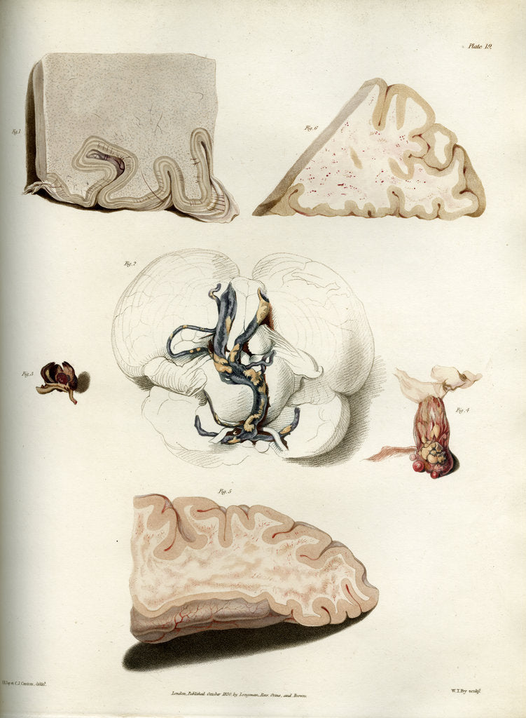 Detail of 'Congestion in the minute vessels of the brain' by William Thomas Fry