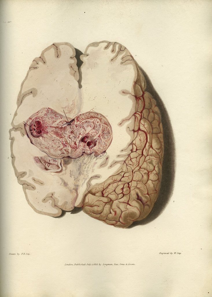 Detail of 'Cyst in the brain' by William Say
