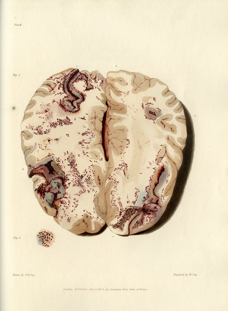 Detail of 'Extravasion in the brain from obstructed circulation' by William Say