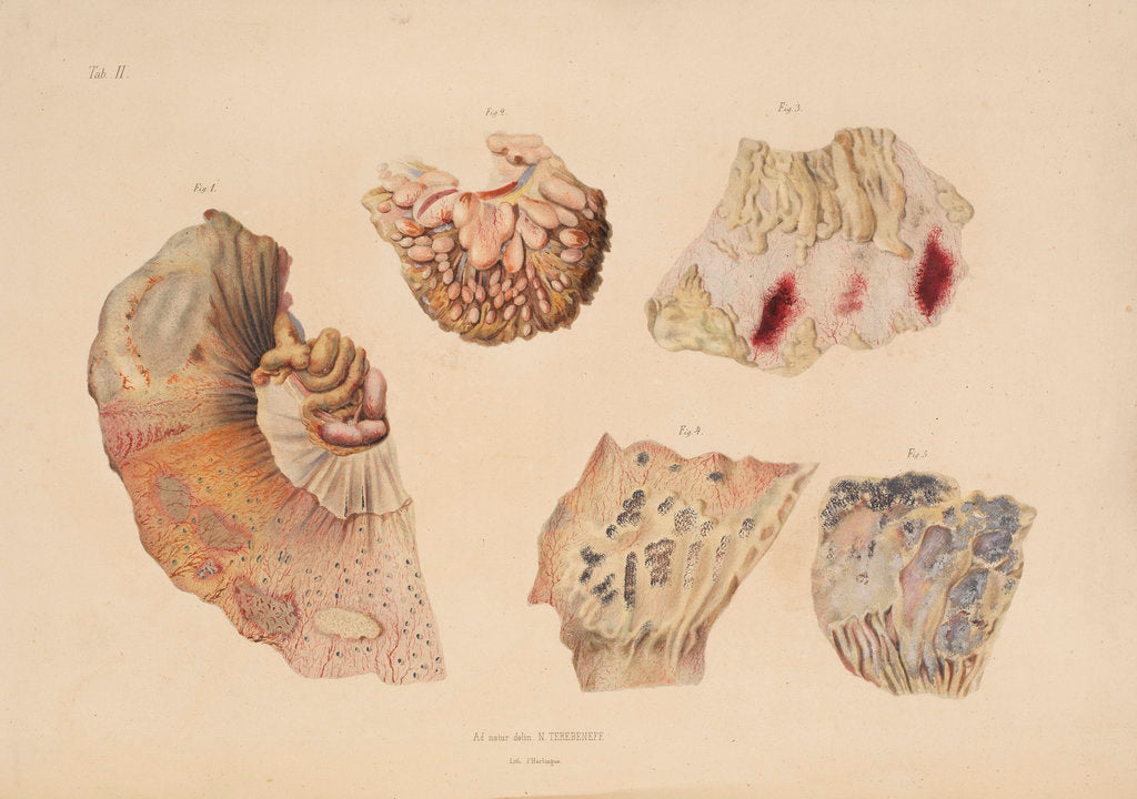 Detail of Effect of cholera on the small intestine by d'Harlingue