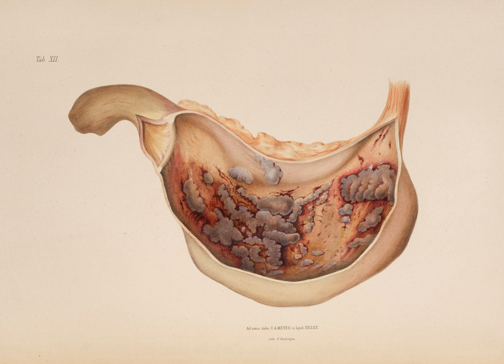 Detail of Effect of diphtheric-cholera on the mucous membrane of the stomach by d'Harlingue
