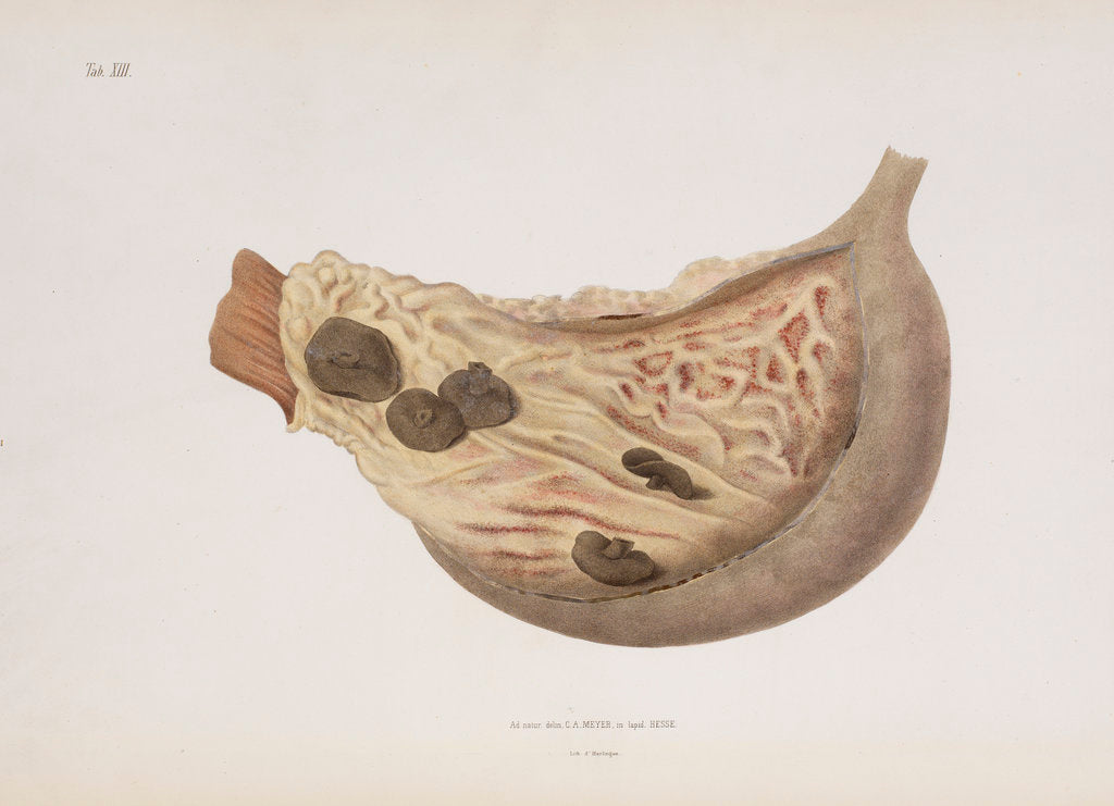 Detail of The stomach of a victim of cholera by d'Harlingue
