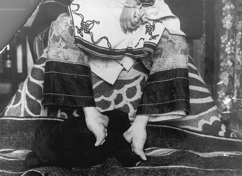 Detail of Chinese Woman Showing Emaciated Deformed Feet by Anonymous
